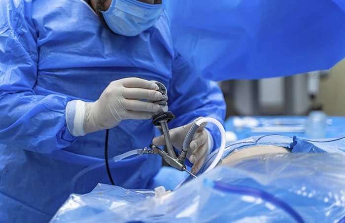 Funduplicatura laparoscópica